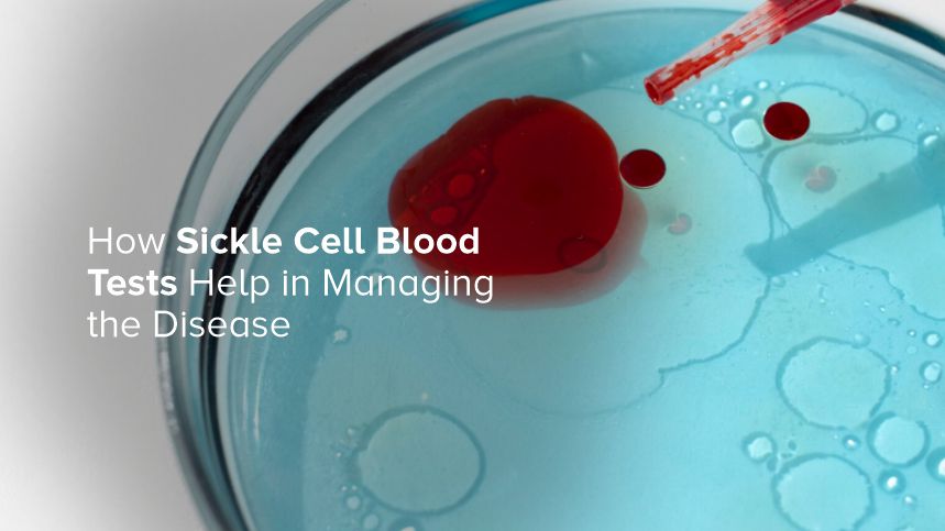 How a Sickle Cell Blood Test Can Save Lives